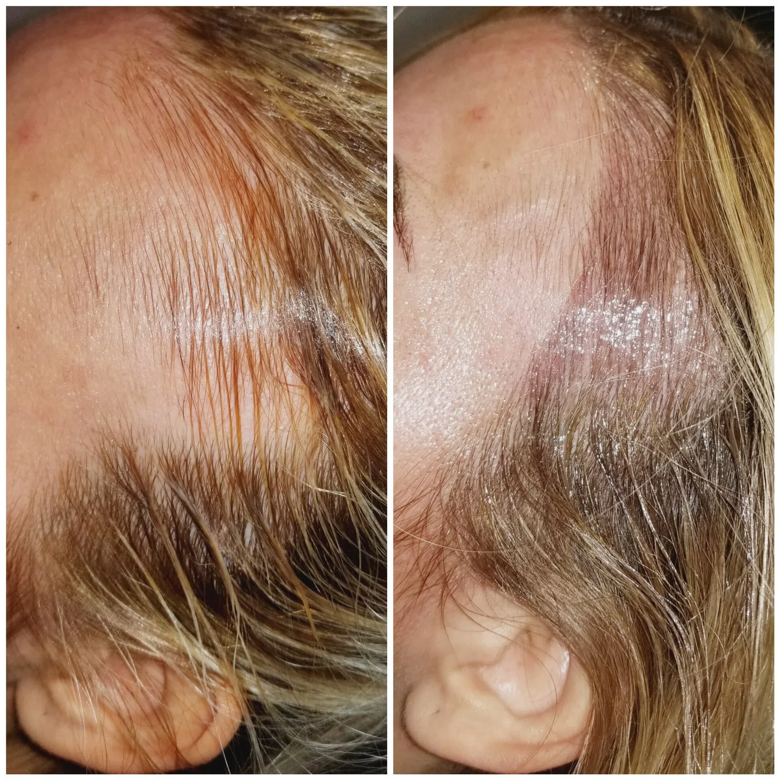 Scalp Micropigmentation result