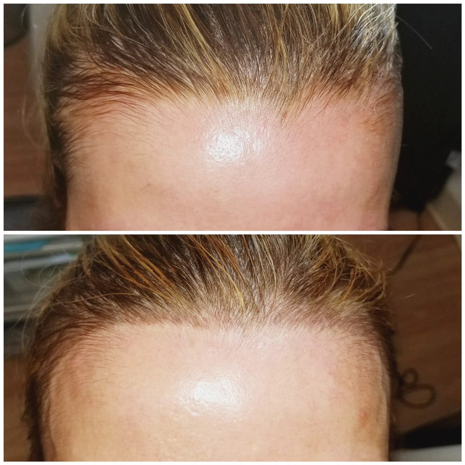 Scalp Micropigmentation result