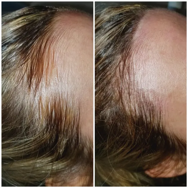 Scalp Micropigmentation result