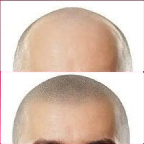 Scalp Micropigmentation result