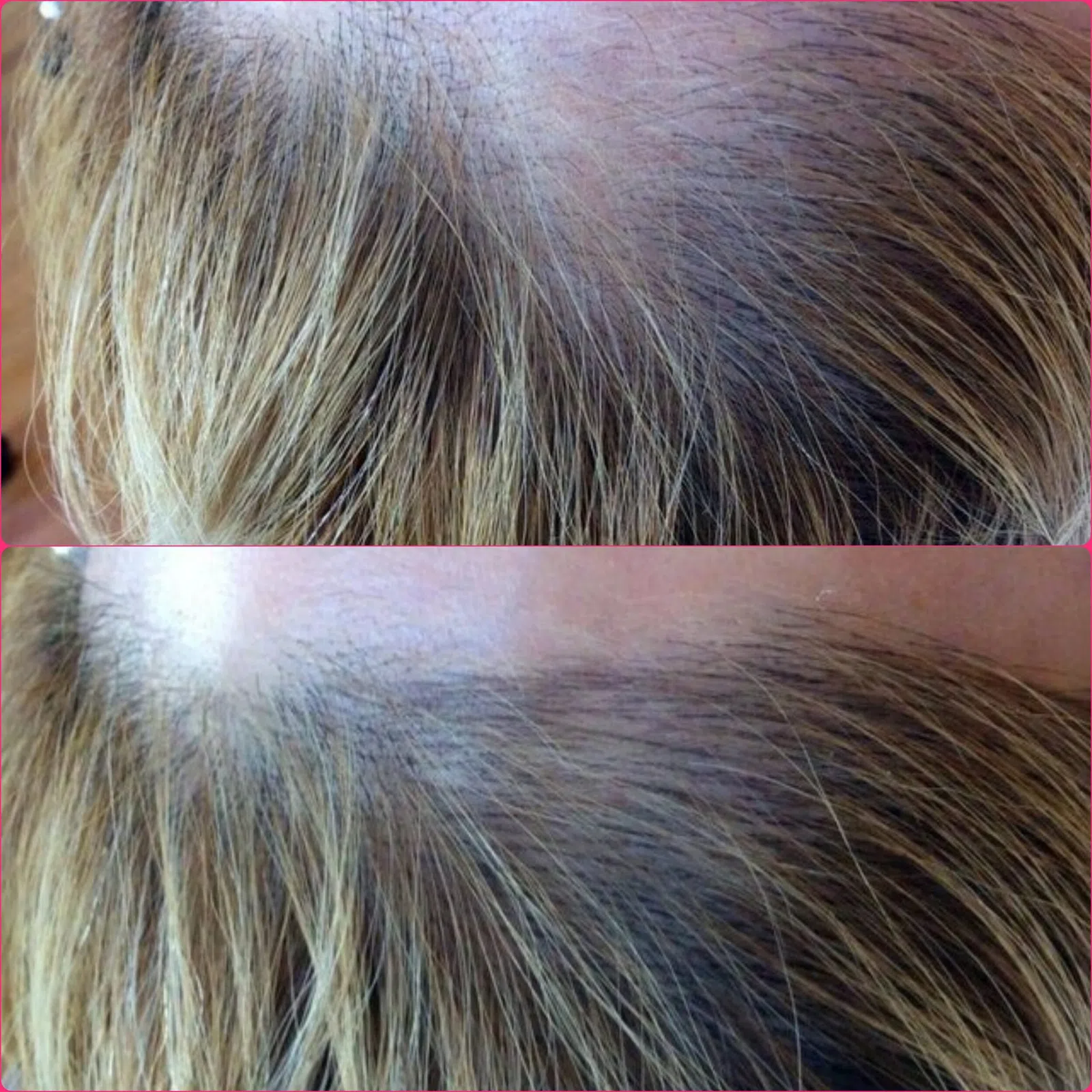 Scalp Micropigmentation result
