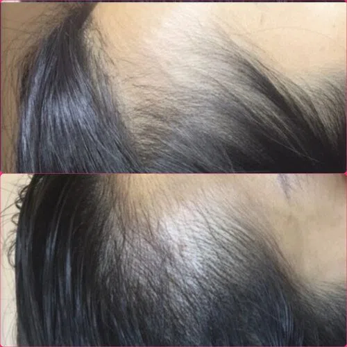 Scalp Micropigmentation result