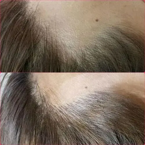 Scalp Micropigmentation result