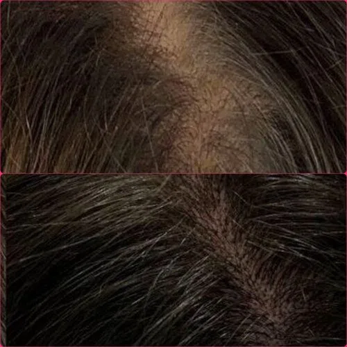 Scalp Micropigmentation result