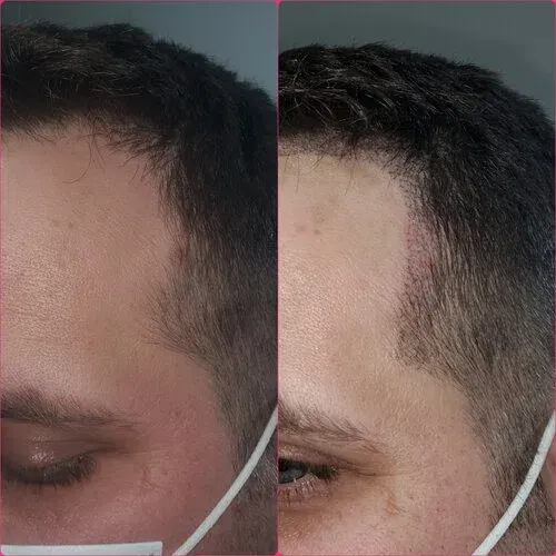 Scalp Micropigmentation result