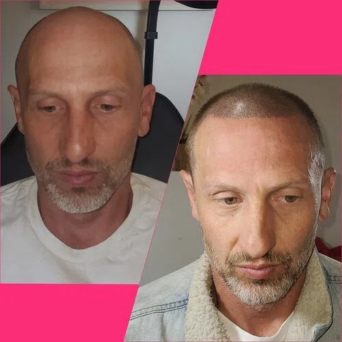 Scalp Micropigmentation result