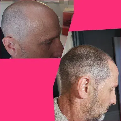 Scalp Micropigmentation result