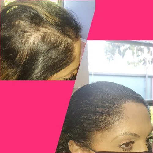 Scalp Micropigmentation result