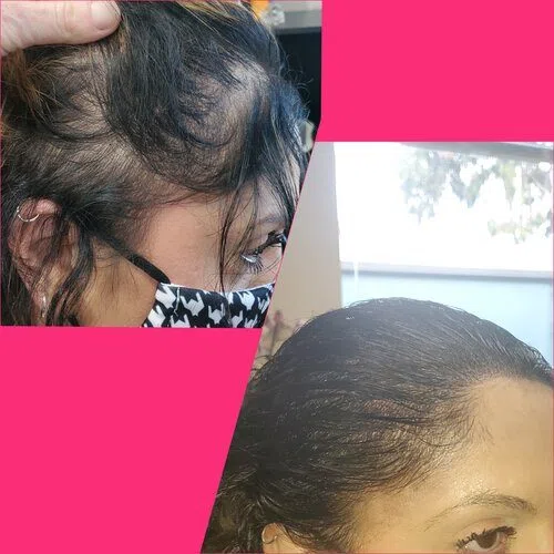 Scalp Micropigmentation result