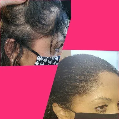 Scalp Micropigmentation result