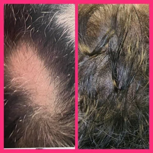 Scalp Micropigmentation result