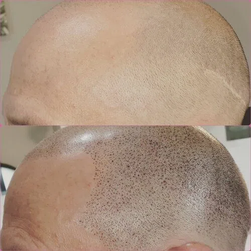 Scalp Micropigmentation result