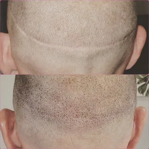Scalp Micropigmentation result