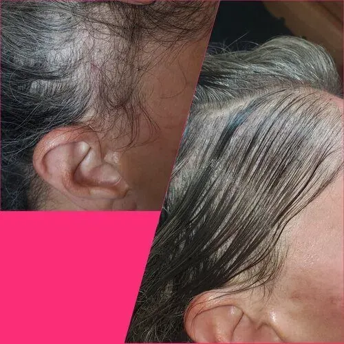 Scalp Micropigmentation result