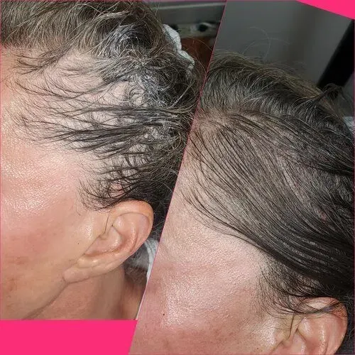 Scalp Micropigmentation result