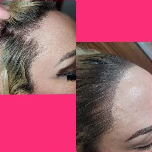 Scalp Micropigmentation result