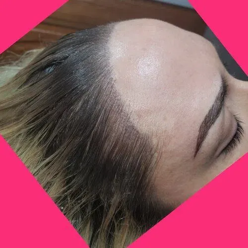 Scalp Micropigmentation result