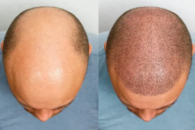 Scalp Micropigmentation: The Secret to Natural-Looking Hair Restoration for Men and Women