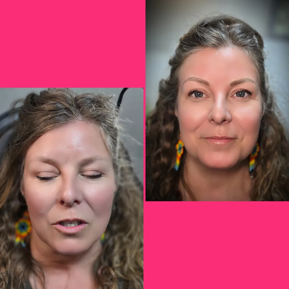 Nano Machine Hair Strokes before, after and healed result 2