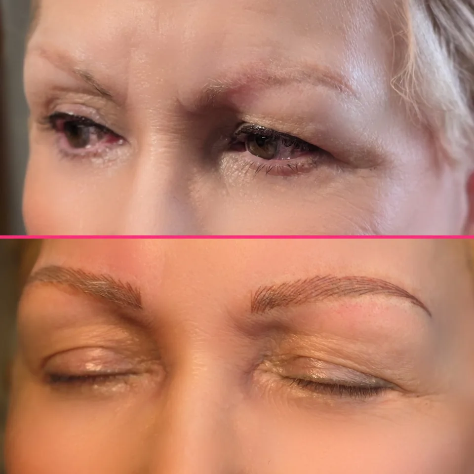 Nano Machine Hair Strokes before, after and healed result 3