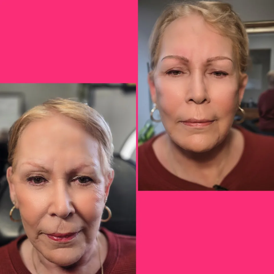 Nano Machine Hair Strokes before, after and healed result 4