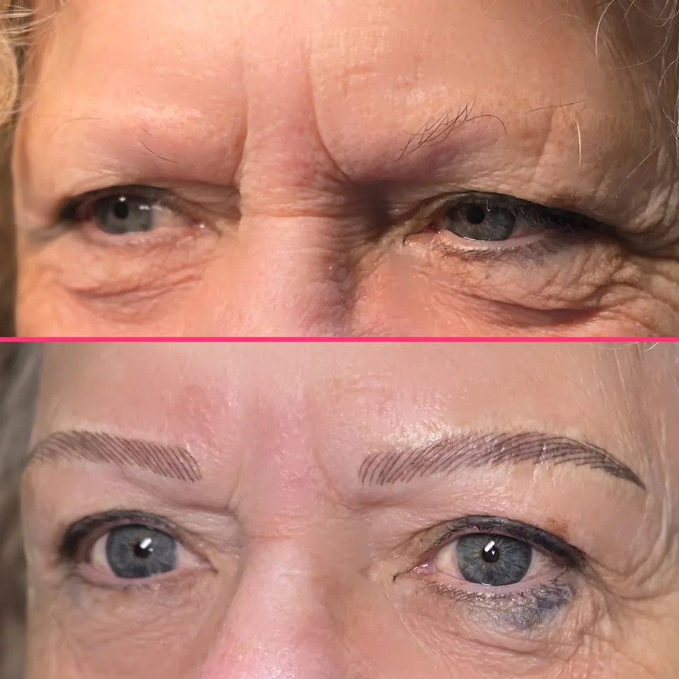 Nano Machine Hair Strokes before, after and healed result 5