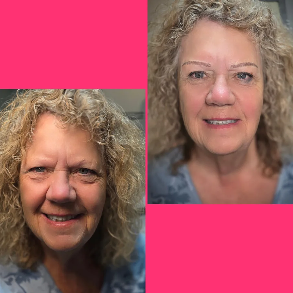 Nano Machine Hair Strokes before, after and healed result 6
