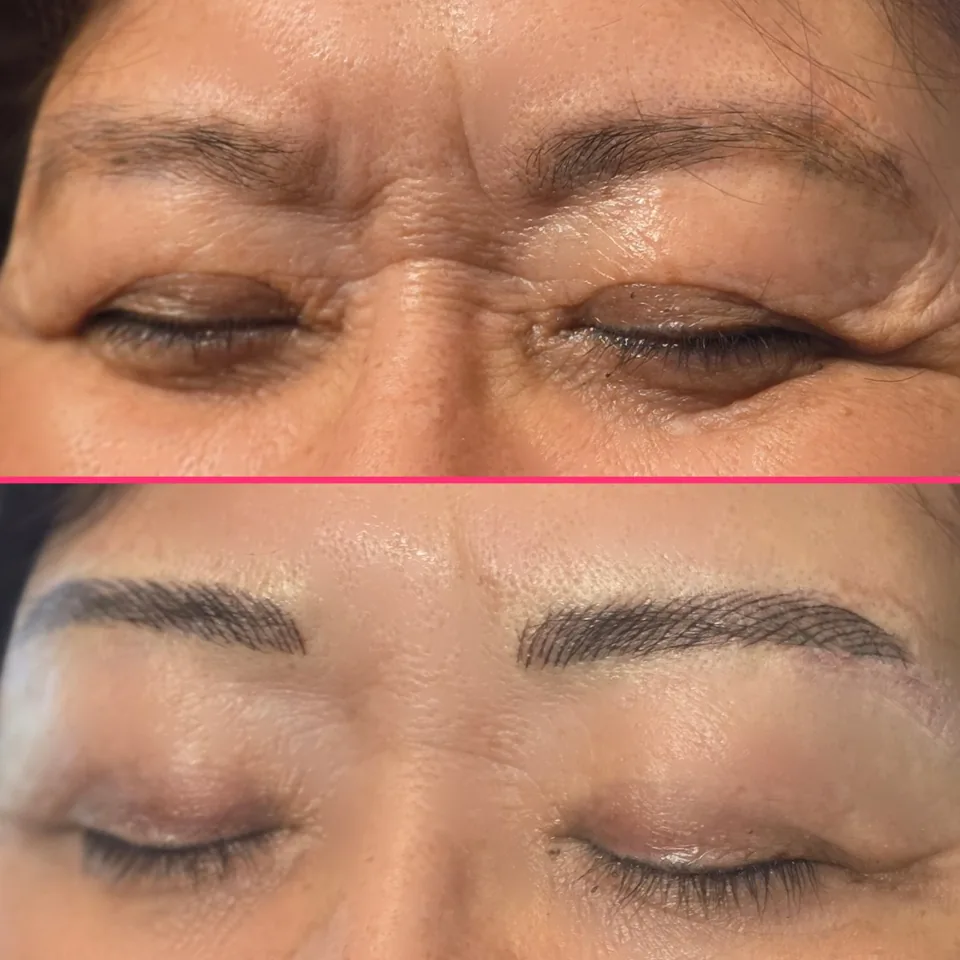 Nano Machine Hair Strokes before, after and healed result 7