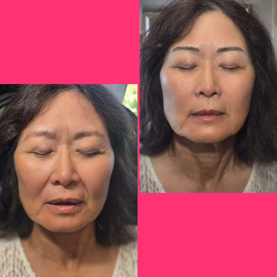Nano Machine Hair Strokes before, after and healed result 8