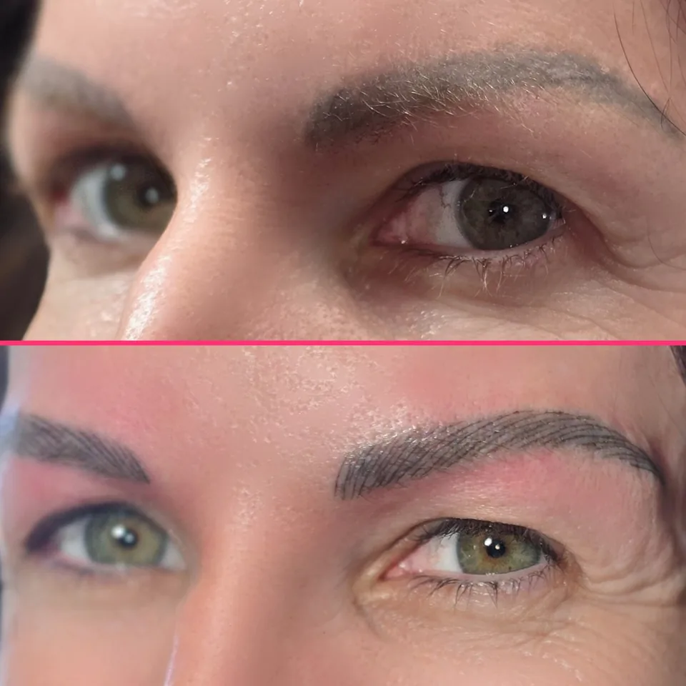 Nano Machine Hair Strokes before, after and healed result 9