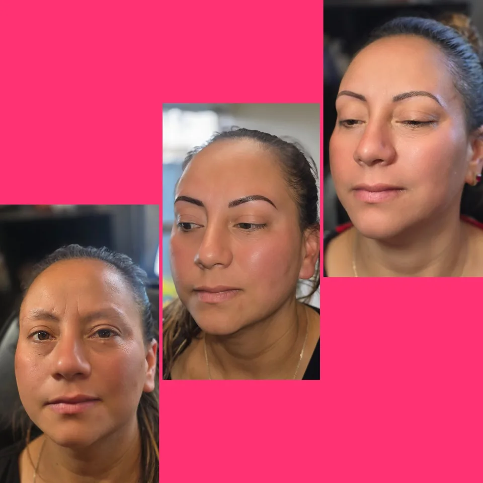 Nano Machine Hair Strokes before, after and healed result 12
