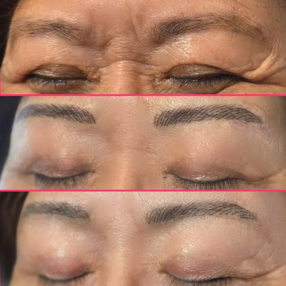 Nano Machine Hair Strokes before, after and healed result 14