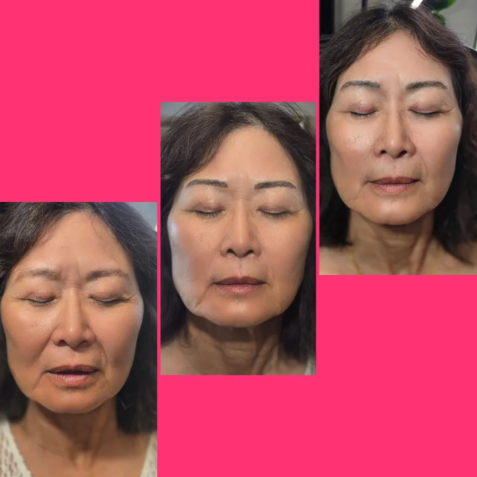 Nano Machine Hair Strokes before, after and healed result 15