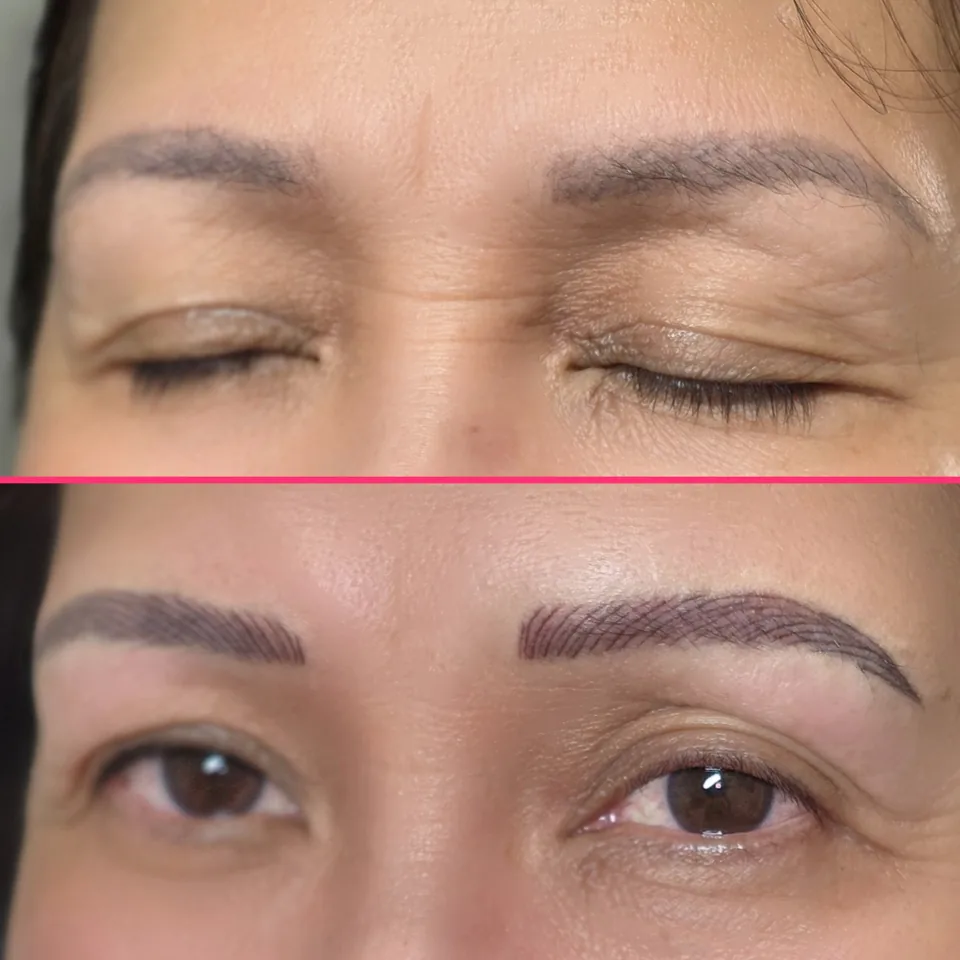 Nano Machine Hair Strokes before, after and healed result 16