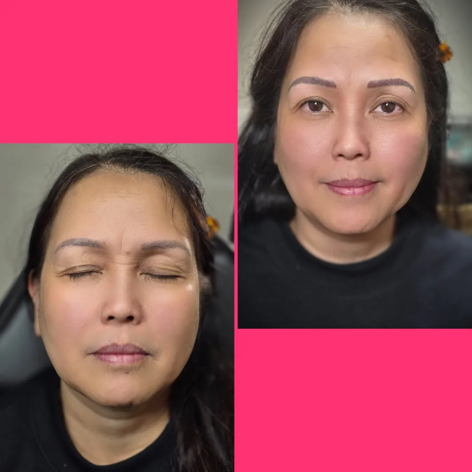 Nano Machine Hair Strokes before, after and healed result 17