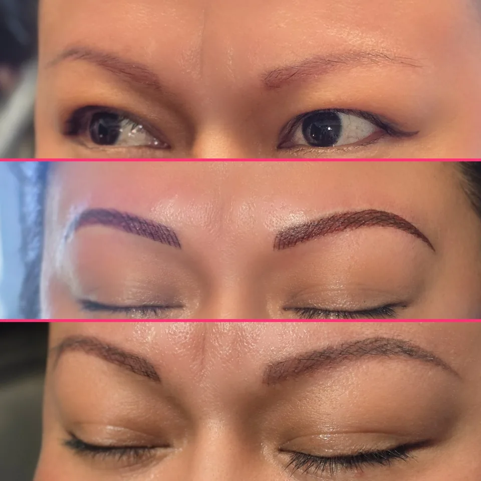 Nano Machine Hair Strokes before, after and healed result 19