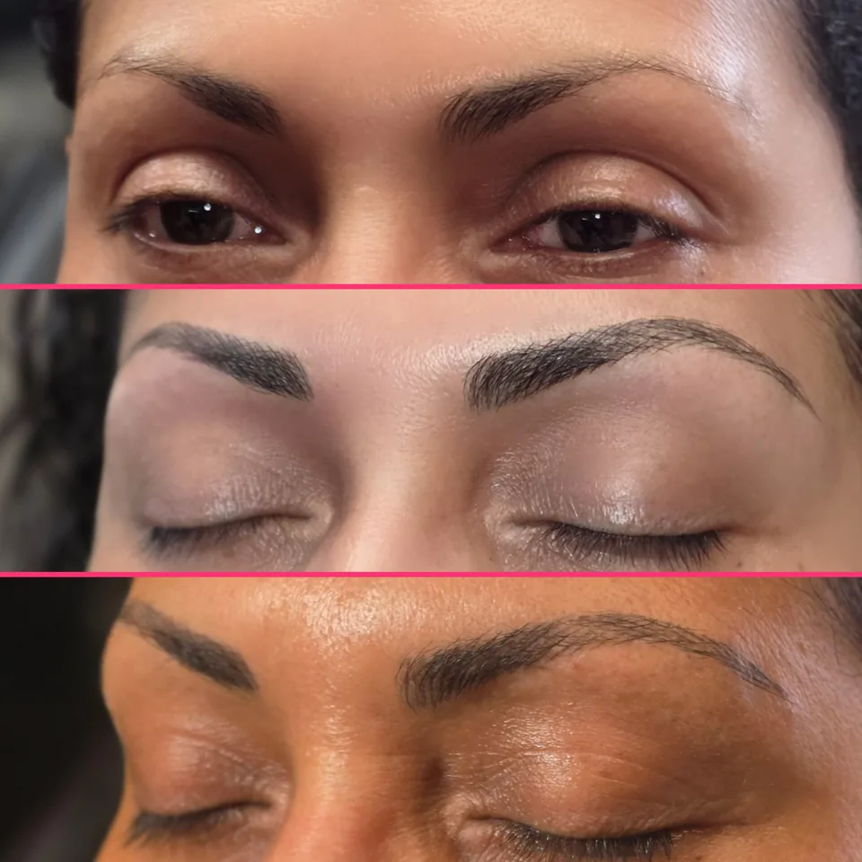 Nano Machine Hair Strokes before, after and healed result 20
