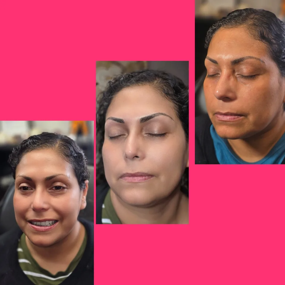 Nano Machine Hair Strokes before, after and healed result 21